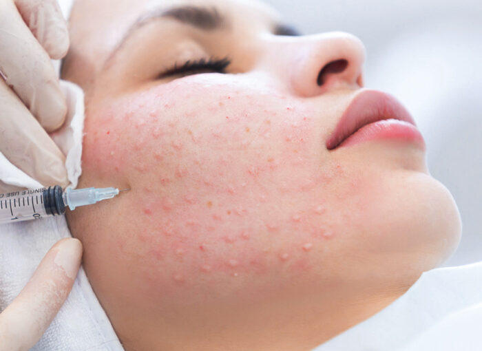 Биоревитализация: руководство по процедуре омоложения кожи