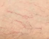 Сосудистые звездочки на ногах: причины, профилактика и современные методы лечения